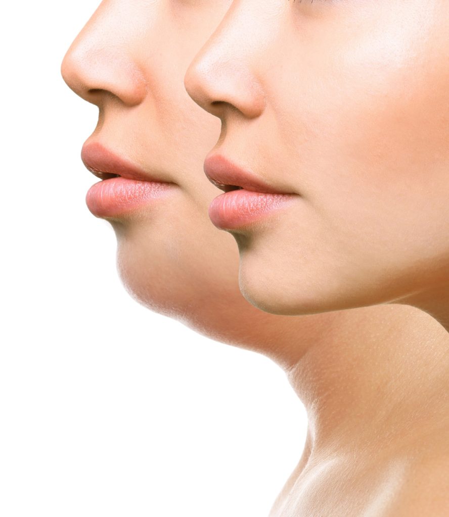 Woman With The Double And Perfect Chin Isolated On White Background | Homa Rejuvenation Center in Oviedo, FL