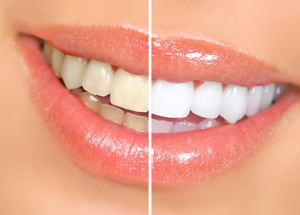 Enhancing Your Smile: The Art of Lip Shape Correction