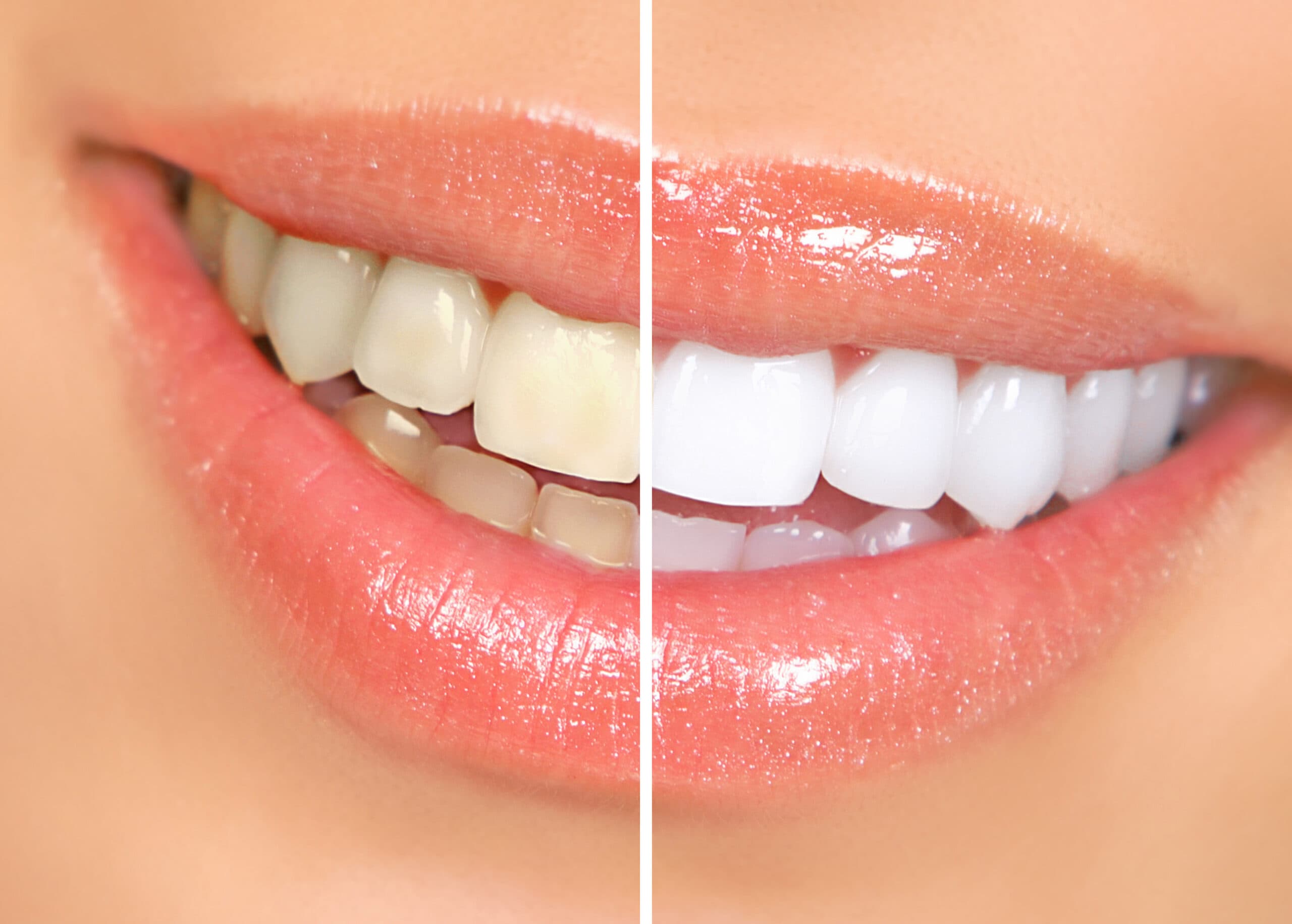 Enhancing Your Smile: The Art of Lip Shape Correction