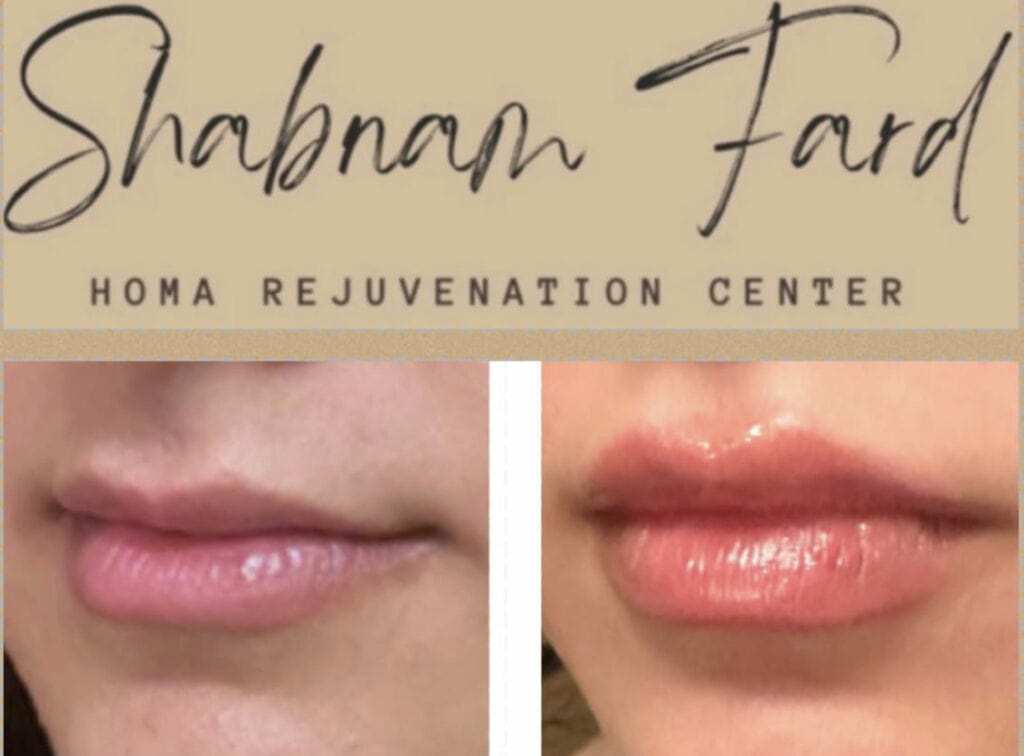 Before and after comparison of lip enhancement at Homa Rejuvenation showing subtle increase in lip volume and improved shape.