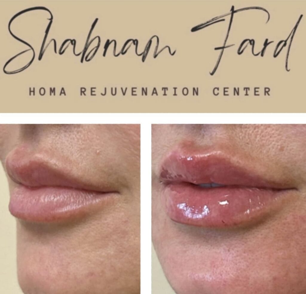 Before and after comparison of lip enhancement at Homa Rejuvenation showing increased lip volume and a fuller appearance.