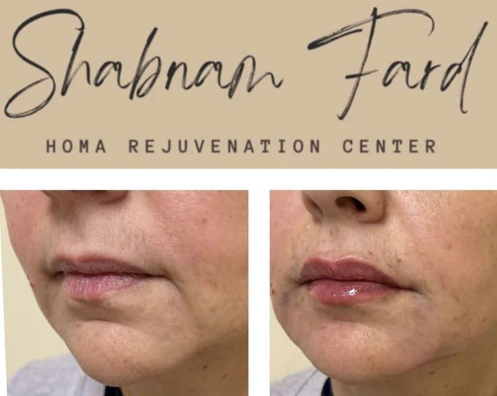 Before and after comparison of lip enhancement at Homa Rejuvenation showing improved lip volume and smoother skin around the mouth.
