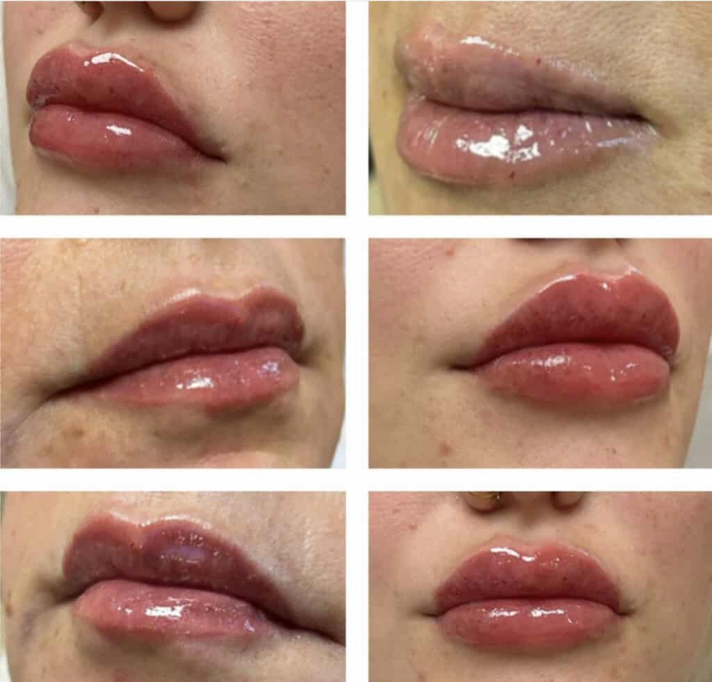 Before and after comparison of lip enhancement at Homa Rejuvenation showing fuller lips with improved shape and volume across multiple results.