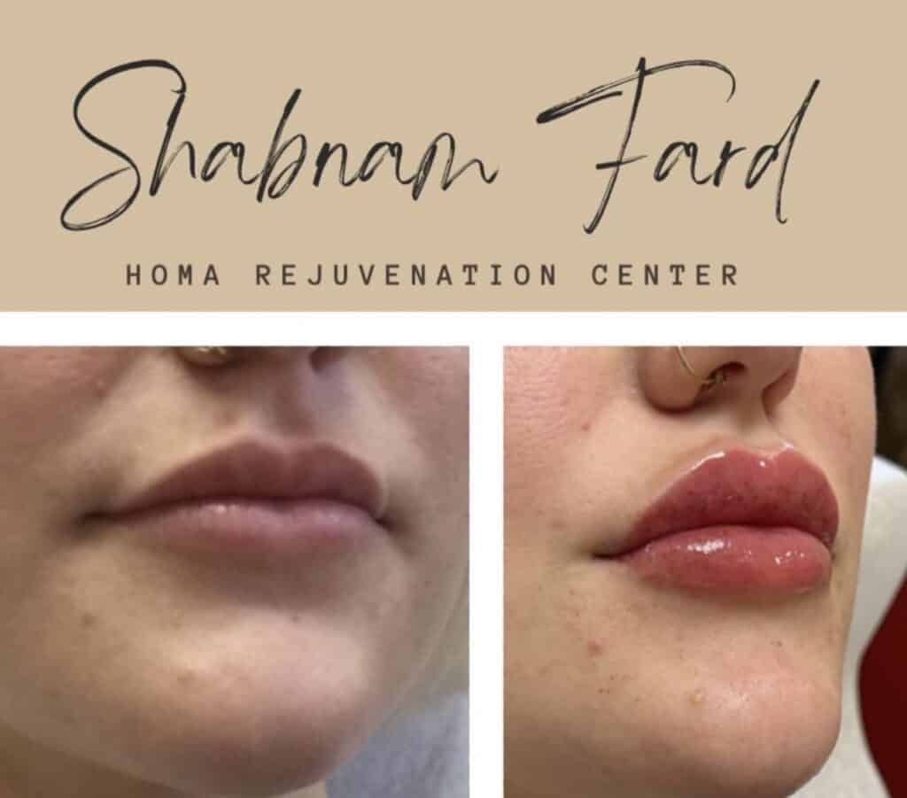 Before and after comparison of lip enhancement at Homa Rejuvenation showing fuller and more defined lips.