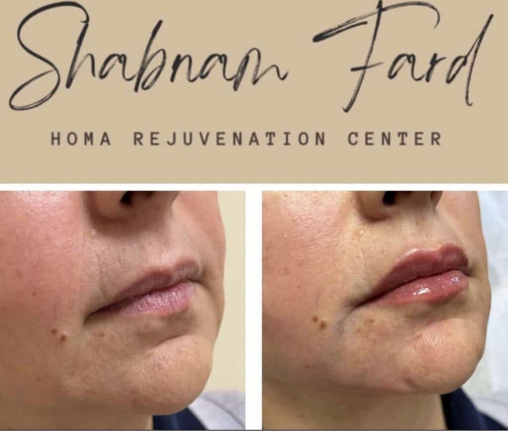 Before and after comparison of lip enhancement at Homa Rejuvenation showing fuller lips and smoother skin around the mouth.