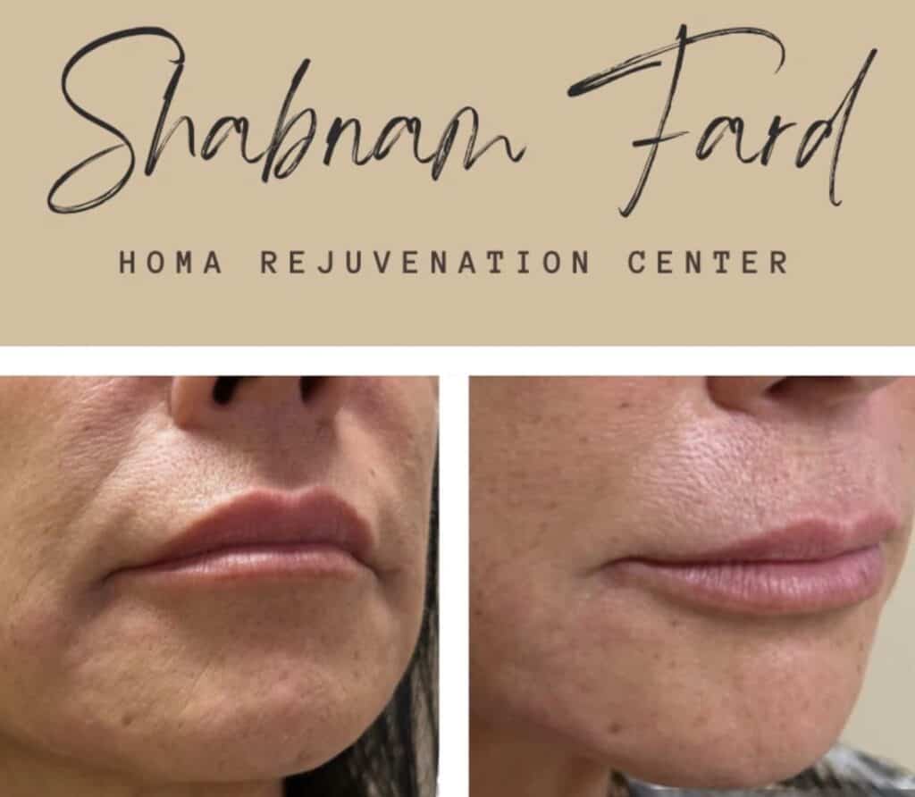 Before and after comparison of facial rejuvenation at Homa Rejuvenation showing smoother skin and softened lines around the mouth.