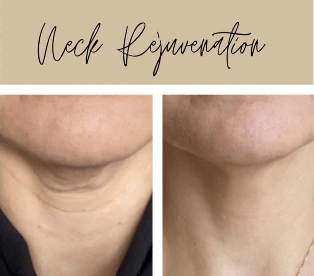 Before and after comparison of Neck Rejuvenation at Homa Rejuvenation, showing smoother and tighter neck skin