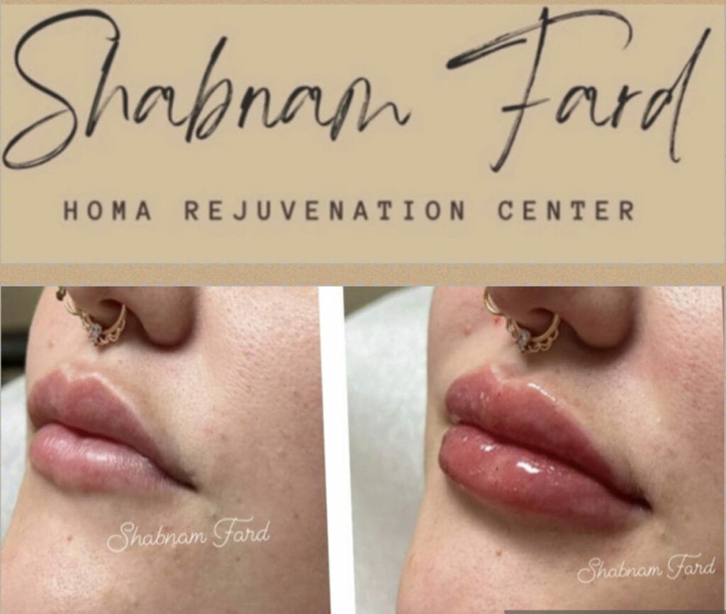 Alt text: Before and after comparison of lip enhancement at Homa Rejuvenation showing improved lip volume and smoother skin around the mouth. Alt text: Before and after comparison of lip enhancement at Homa Rejuvenation showing increased lip volume and a fuller appearance. Alt text: Before and after comparison of under eye rejuvenation with UPNEEQ at Homa Rejuvenation showing a more open and lifted eye appearance. Alt text: Before and after comparison of lip enhancement at Homa Rejuvenation showing increased lip volume and improved definition with arrows highlighting treated areas. Alt text: Before and after comparison of lip enhancement at Homa Rejuvenation showing fuller lips with improved shape and symmetry across multiple results. Alt text: Before and after comparison of lip enhancement at Homa Rejuvenation showing fuller lips with enhanced volume and definition across multiple angles. Alt text: Portrait of a smiling provider at Homa Rejuvenation standing in a treatment room wearing a white coat with decorative wall art in the background. Shabnam Alt text: Portrait of Shabnam at Homa Rejuvenation smiling in a treatment room wearing a white coat with decorative wall art in the background. Alt text: Before and after comparison of lip enhancement at Homa Rejuvenation showing fuller lips with enhanced volume and smooth, glossy appearance across multiple views. Alt text: Before and after comparison of lip enhancement at Homa Rejuvenation showing improved lip shape and subtle increase in volume. Alt text: Before and after comparison of lip enhancement at Homa Rejuvenation showing increased lip volume and more defined shape.