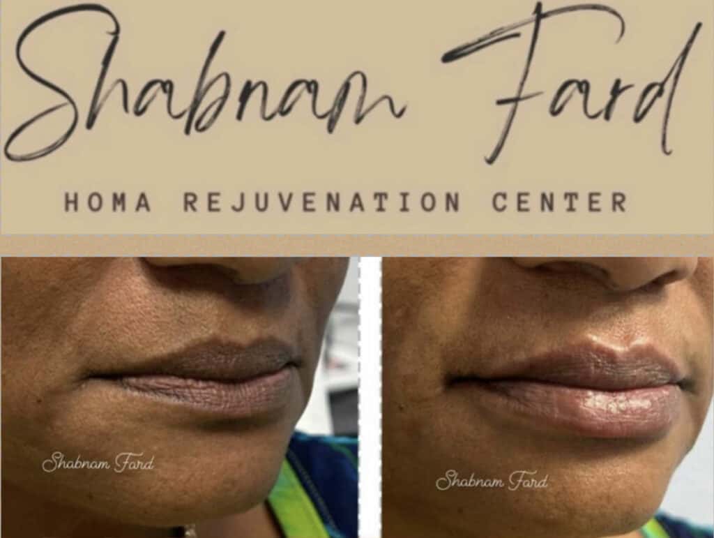 Before and after comparison of lip enhancement at Homa Rejuvenation showing improved lip shape and subtle increase in volume.