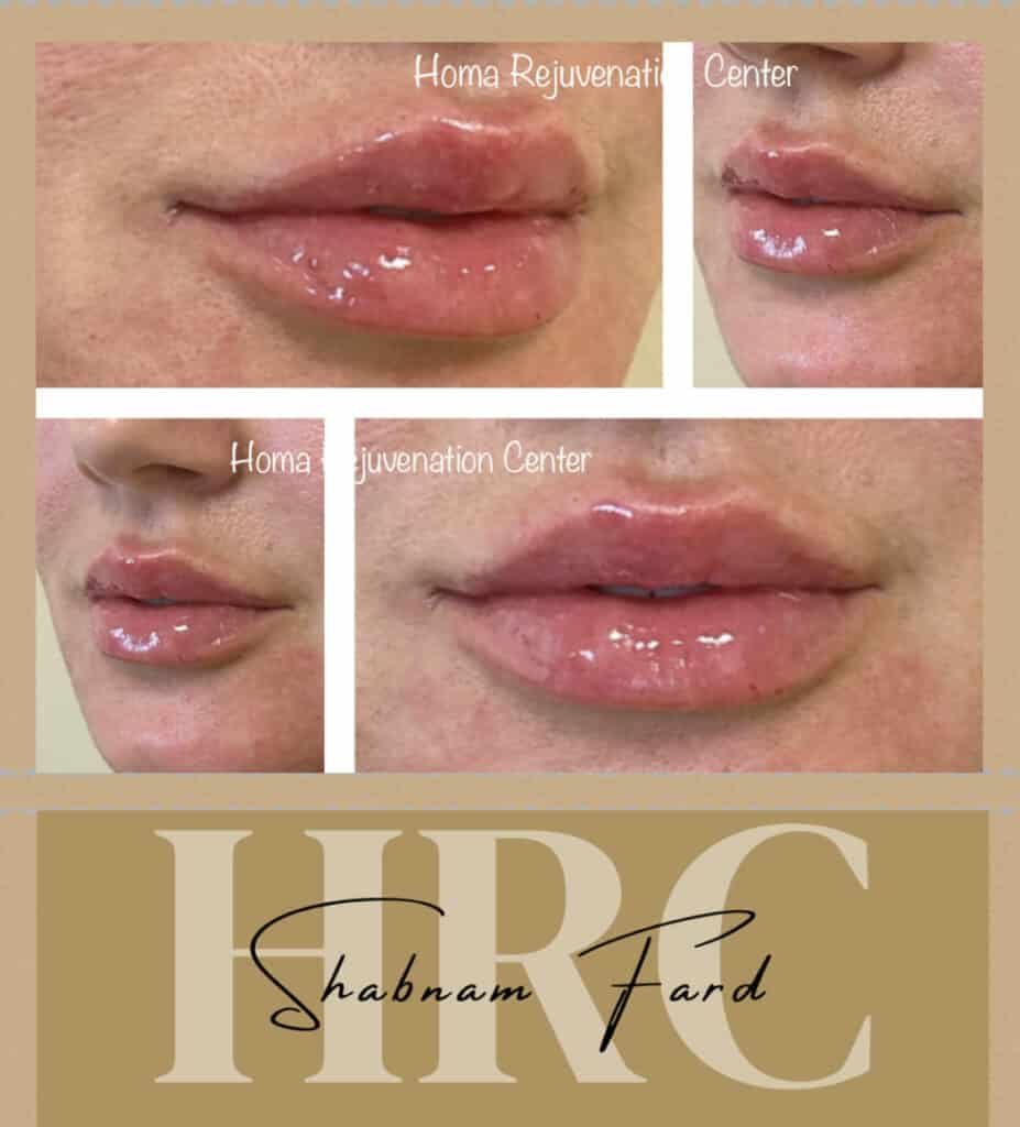 Before and after comparison of lip enhancement at Homa Rejuvenation showing fuller lips with enhanced volume and smooth, glossy appearance across multiple views.