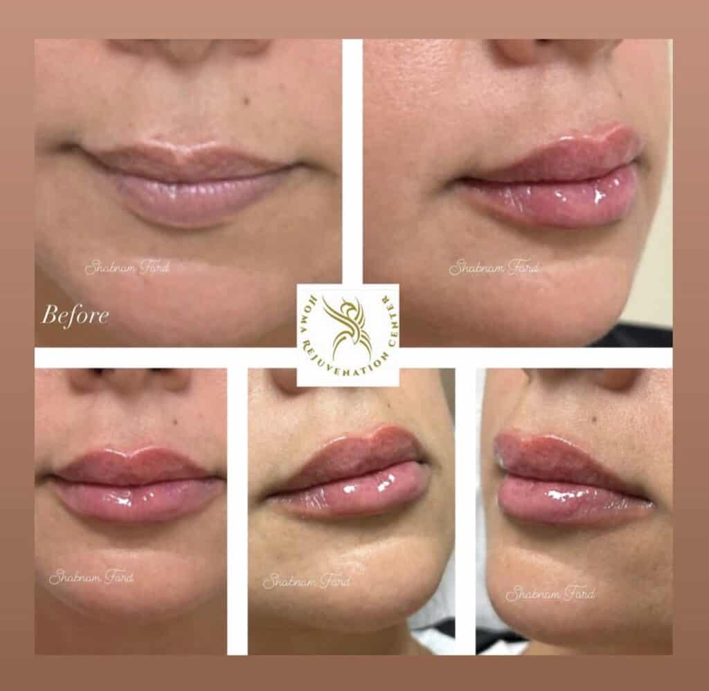 Before and after comparison of lip enhancement at Homa Rejuvenation showing fuller lips with enhanced volume and definition across multiple angles.