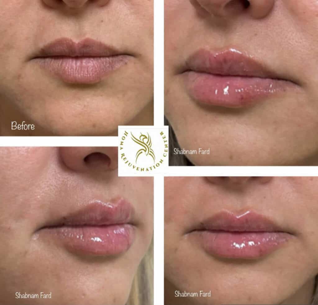 Before and after comparison of lip enhancement at Homa Rejuvenation showing fuller lips with improved shape and symmetry across multiple results.