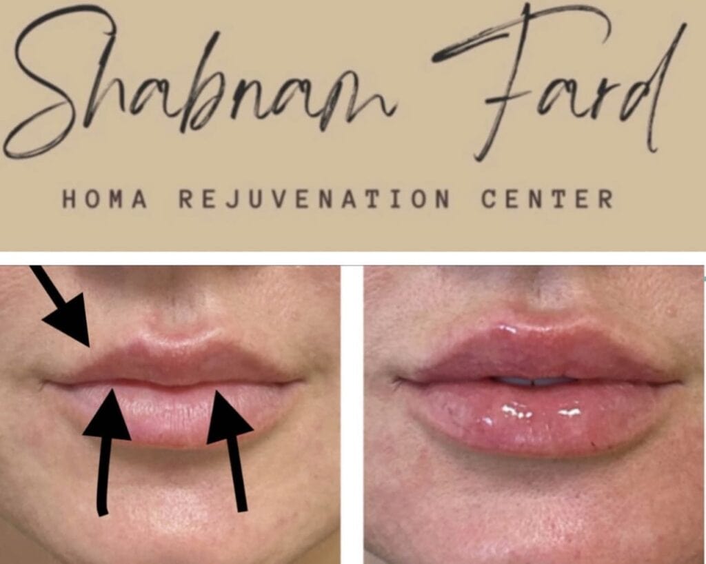 Before and after comparison of lip enhancement at Homa Rejuvenation showing increased lip volume and improved definition with arrows highlighting treated areas.