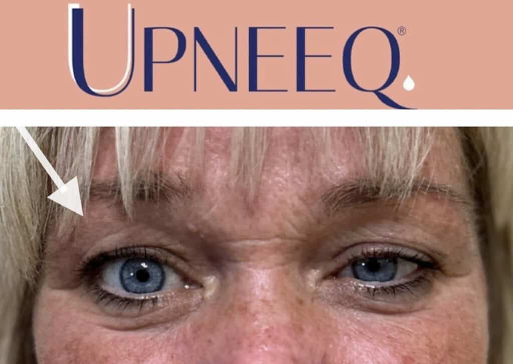 under eye rejuvenation with UPNEEQ at Homa Rejuvenation showing a more open and lifted eye appearance.
