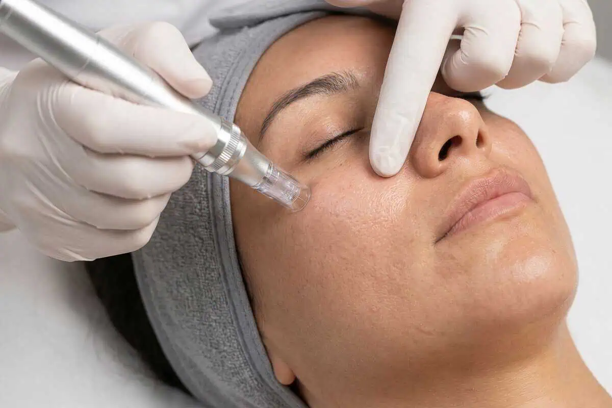 salmon dna microneedling facial therapy for skin rejuvenation and collagen support